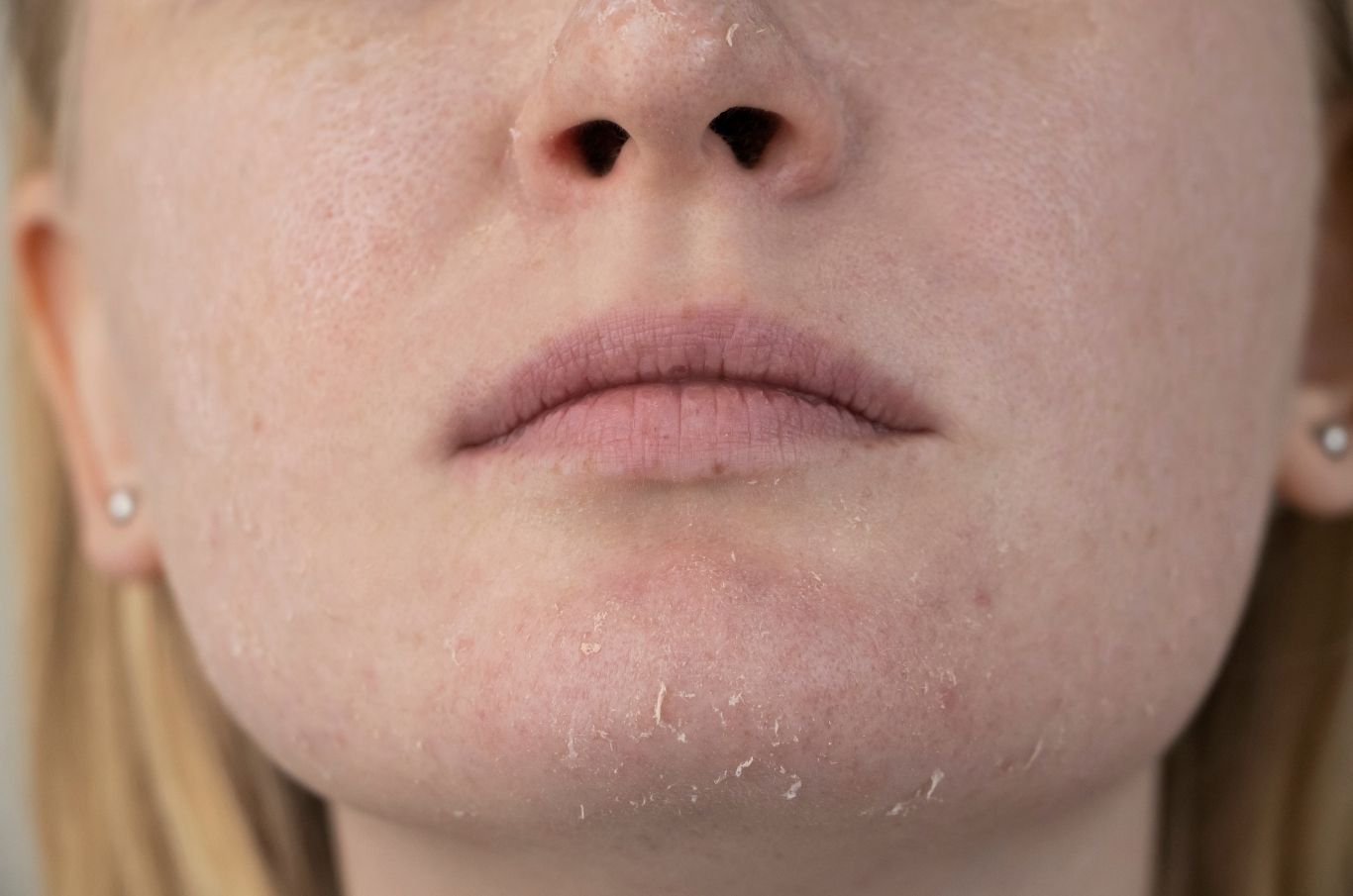 very dry skin on face