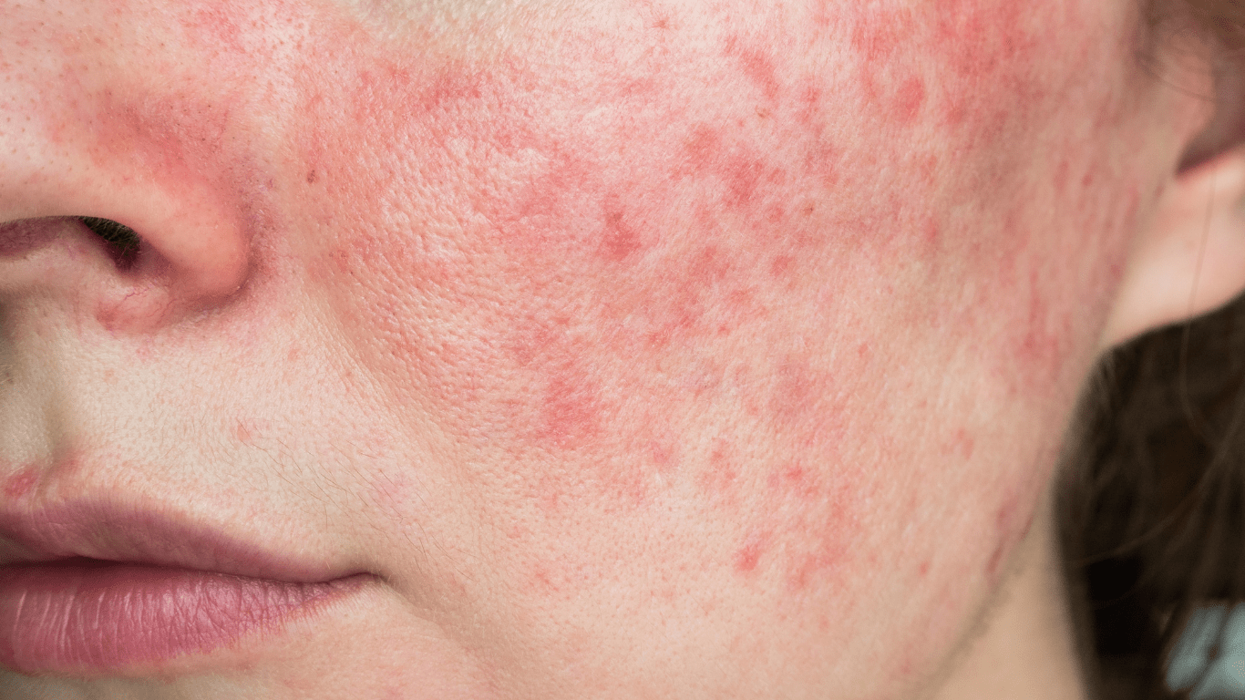 Comment se débarrasser des taches rouges sur le visage ?