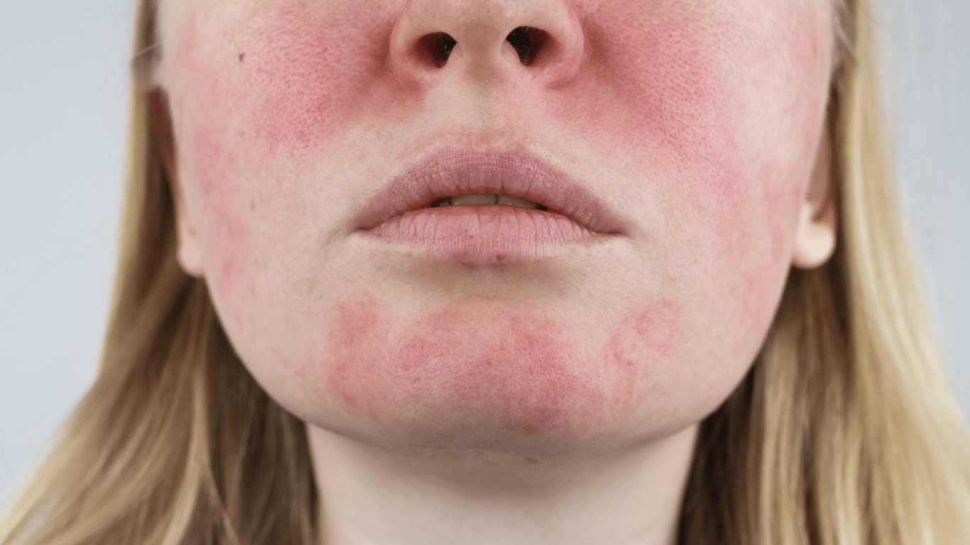 Rosacée sur le visage