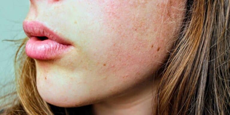 Sucha, ściągnięta i zaczerwieniona skóra po umyciu