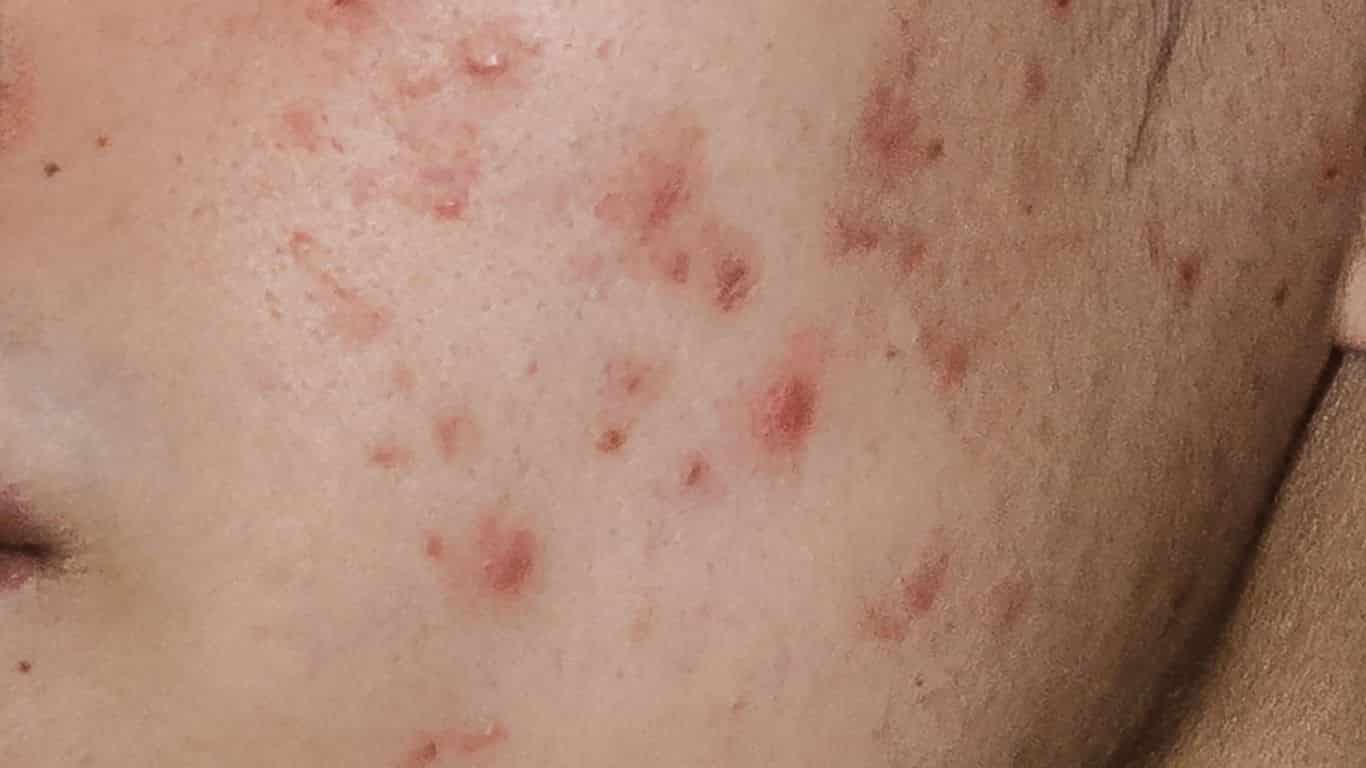 niacynamid na skórę trądzikową, nadreaktywna, na zmiany pozapalne, przebarwienia