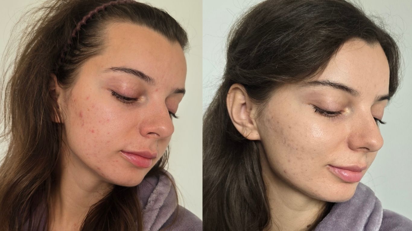 acné hormonale avant après 4 semaines de soin, cosmétiques pure raw rich Alexandra Kubas