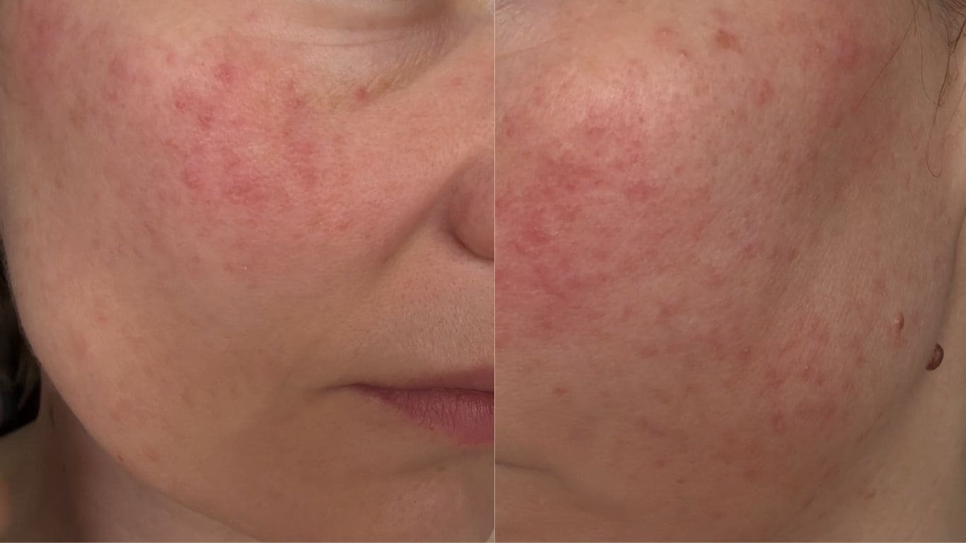 czerwone plamy na twarzy