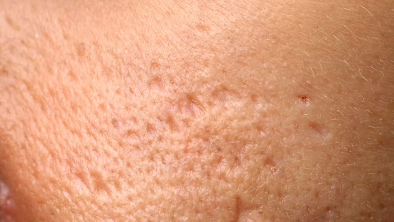 Blizny, dziury po trądziku