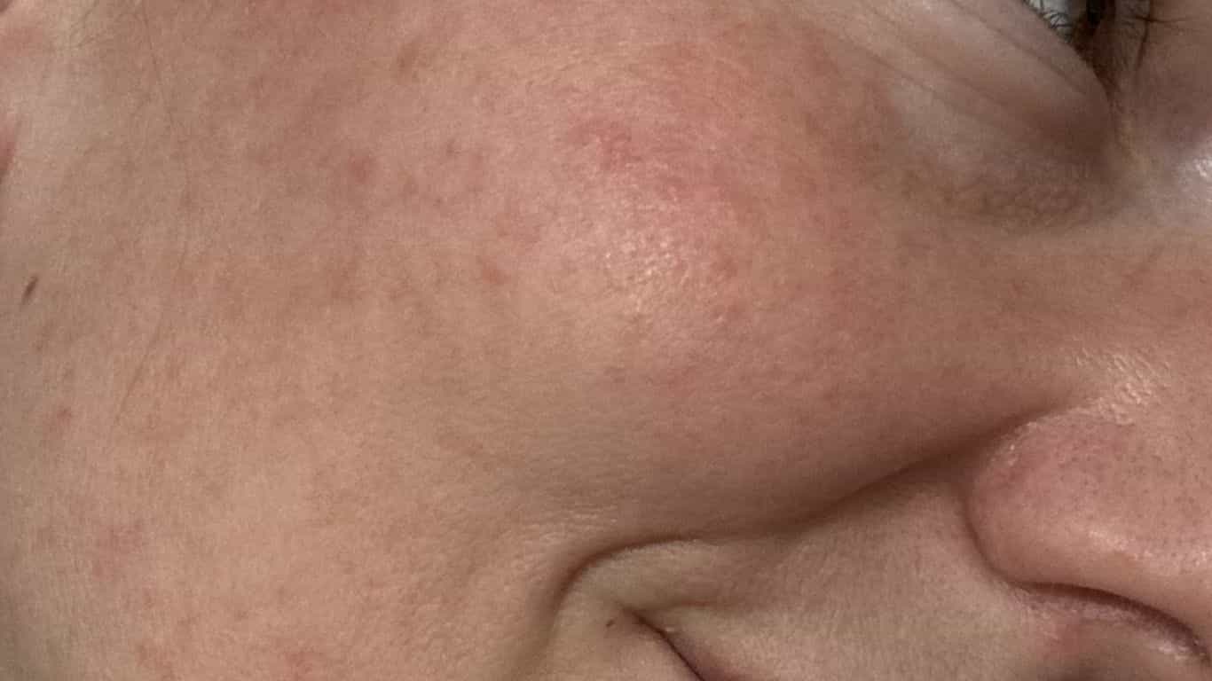 Kwas azelainowy efekty na skórze wrażliwej