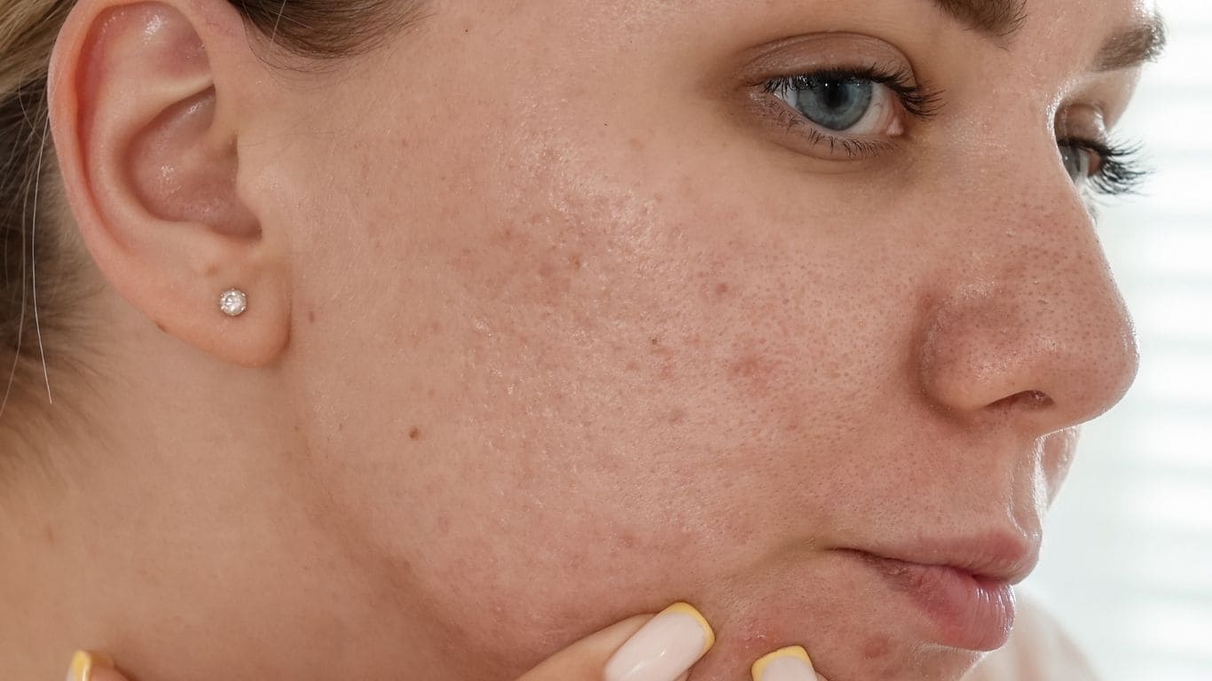 Trądzik kosmetyczny objawy