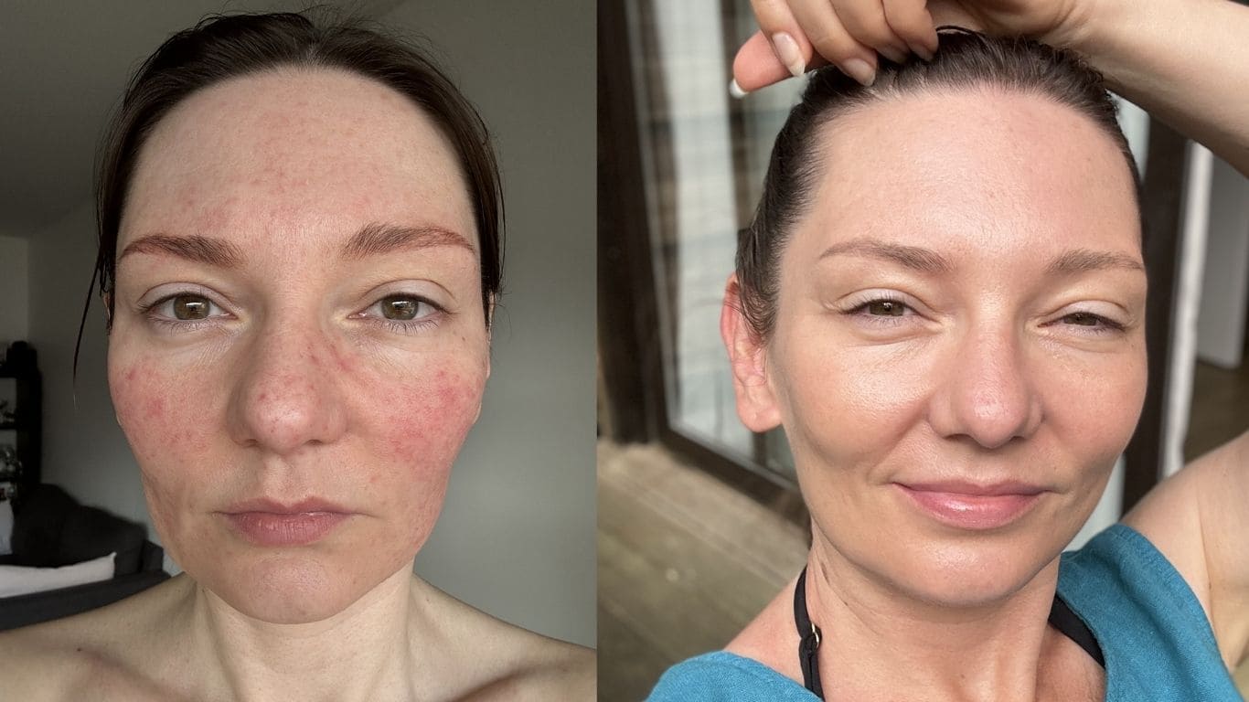 Comment j'ai soigné ma rosacée - avant et après les soins Alexandra Kubas