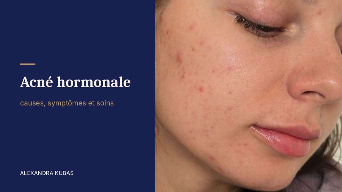 Acné hormonale - boutons sur la joue et la mâchoire