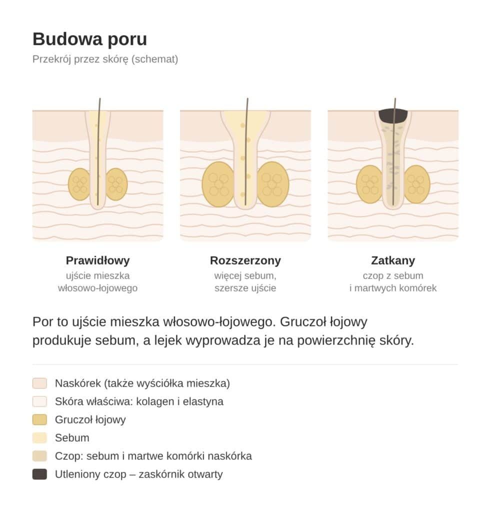 Schemat budowy poru: por prawidłowy, rozszerzony i zatkany czopem z sebum
