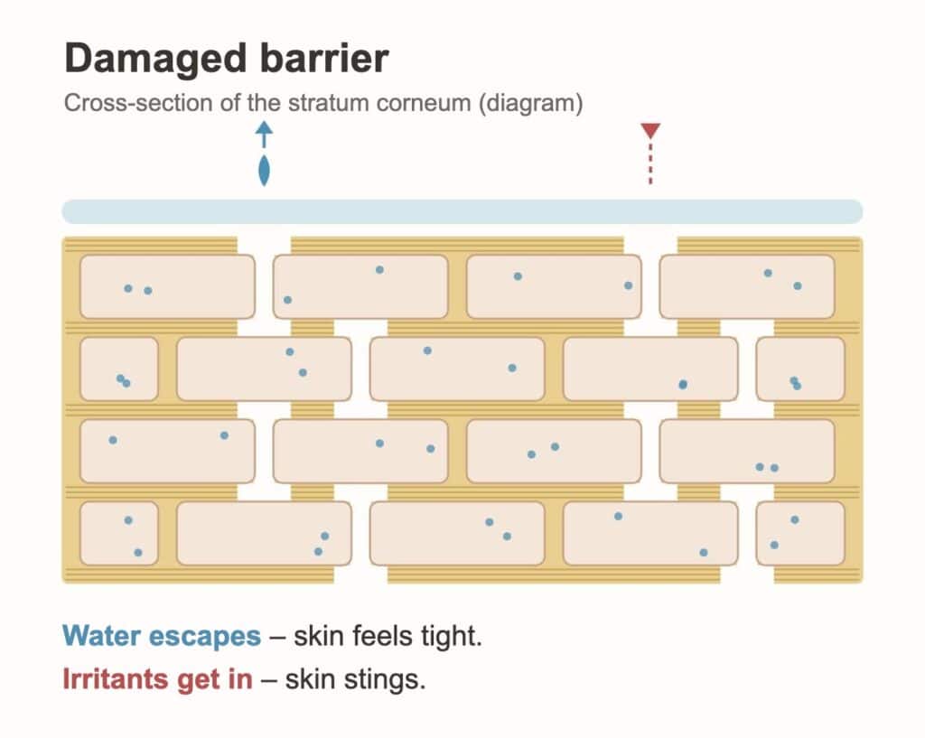 Damaged skin barrier diagram: gaps in the lipid mortar let water escape and irritants get in