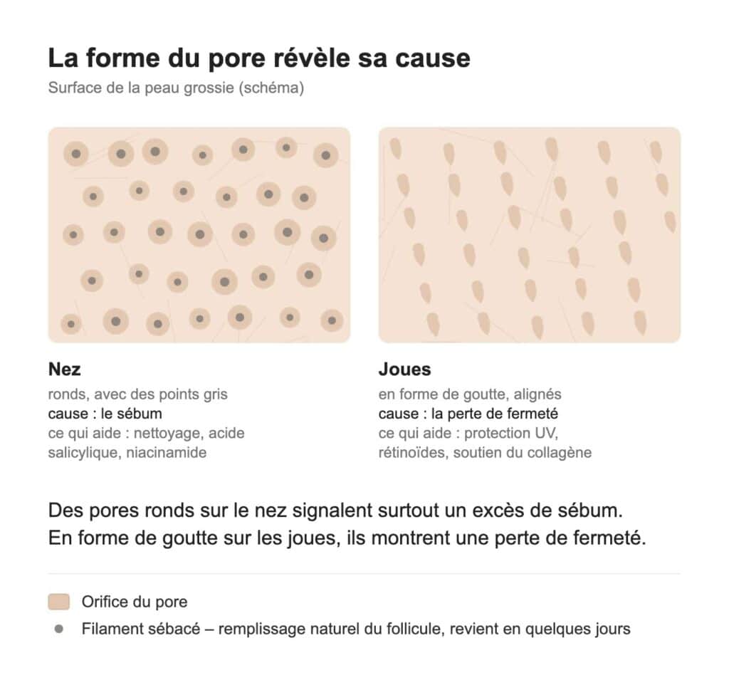 Schéma : pores ronds sur le nez et pores en forme de goutte sur les joues, avec leurs causes