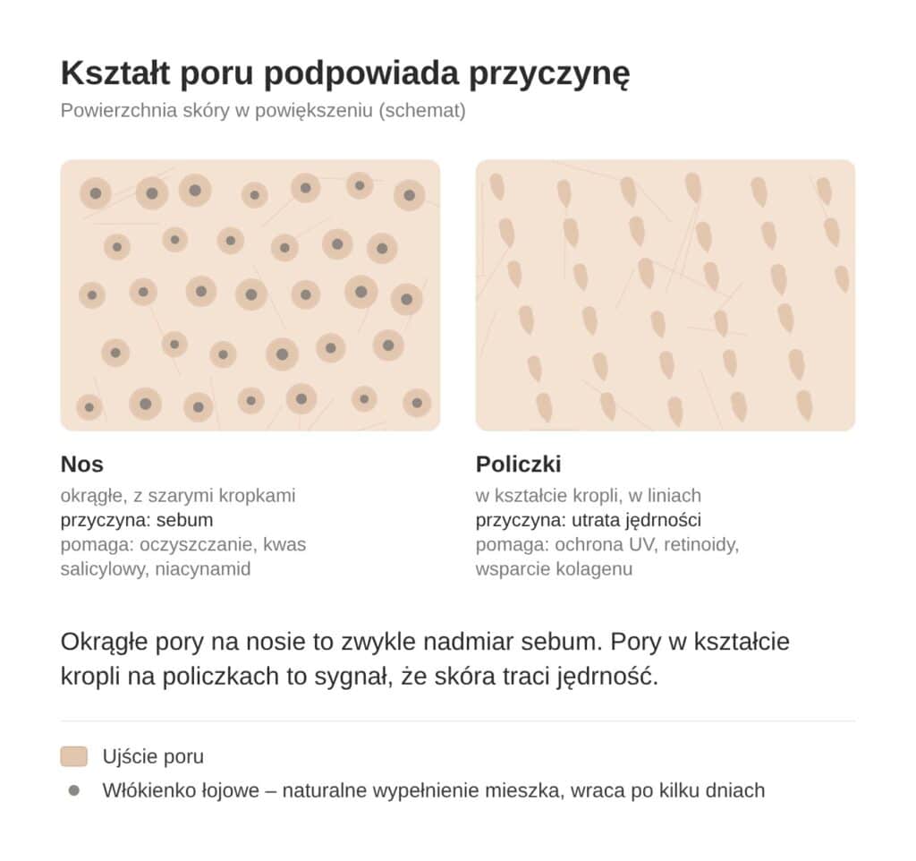 Okrągłe pory na nosie i pory w kształcie kropli na policzkach – schemat przyczyn