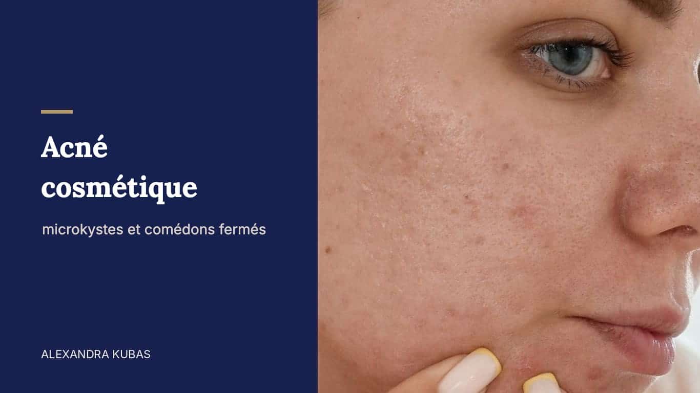 Acné cosmétique : microkystes et comédons fermés sur la joue