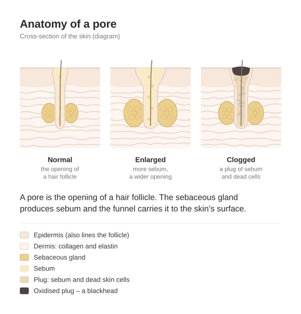 Diagram of pore anatomy: a normal pore, an enlarged pore and a pore clogged with a sebum plug