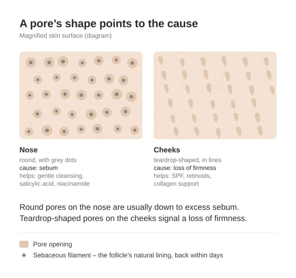 Round pores on the nose and teardrop-shaped pores on the cheeks – diagram of the causes