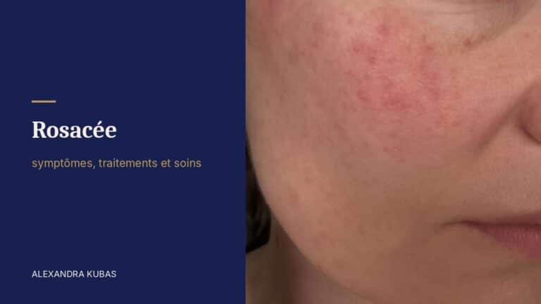 Rosacée - rougeurs et boutons sur la joue