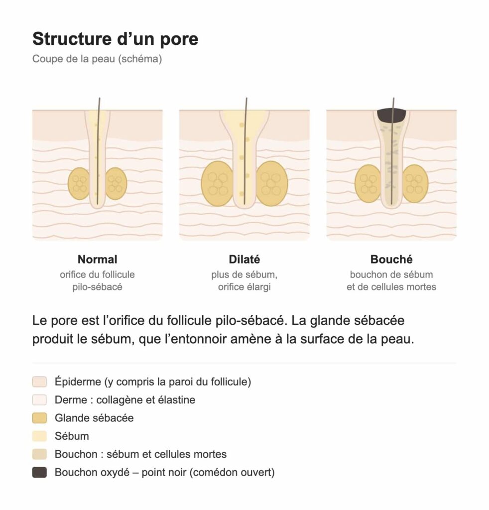 Schéma de la structure d’un pore : pore normal, pore dilaté et pore bouché par du sébum